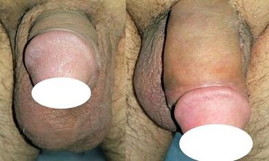 Photos before and after increasing the penis